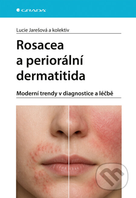 Rosacea a periorální dermatitida-Lucie Jarešová